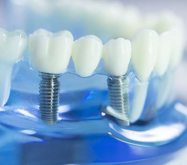 Santa Ana Dental Implants